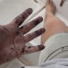 Hands coated with epoxy